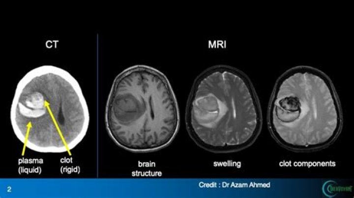 Do mini strokes show up on MRI?